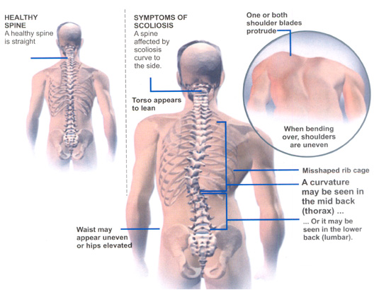 What are the Symptoms of Scoliosis